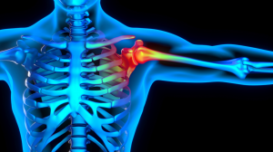 What Causes Frozen Shoulder? Common Triggers and Risk Factors 